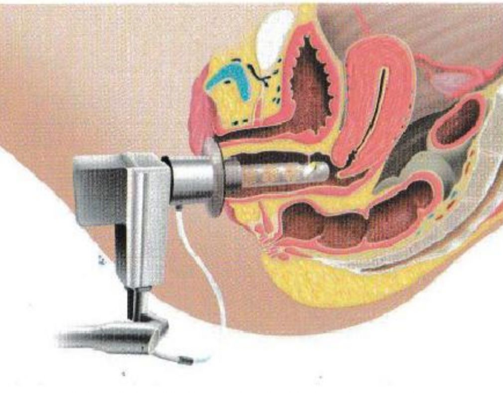 GYNELASETM